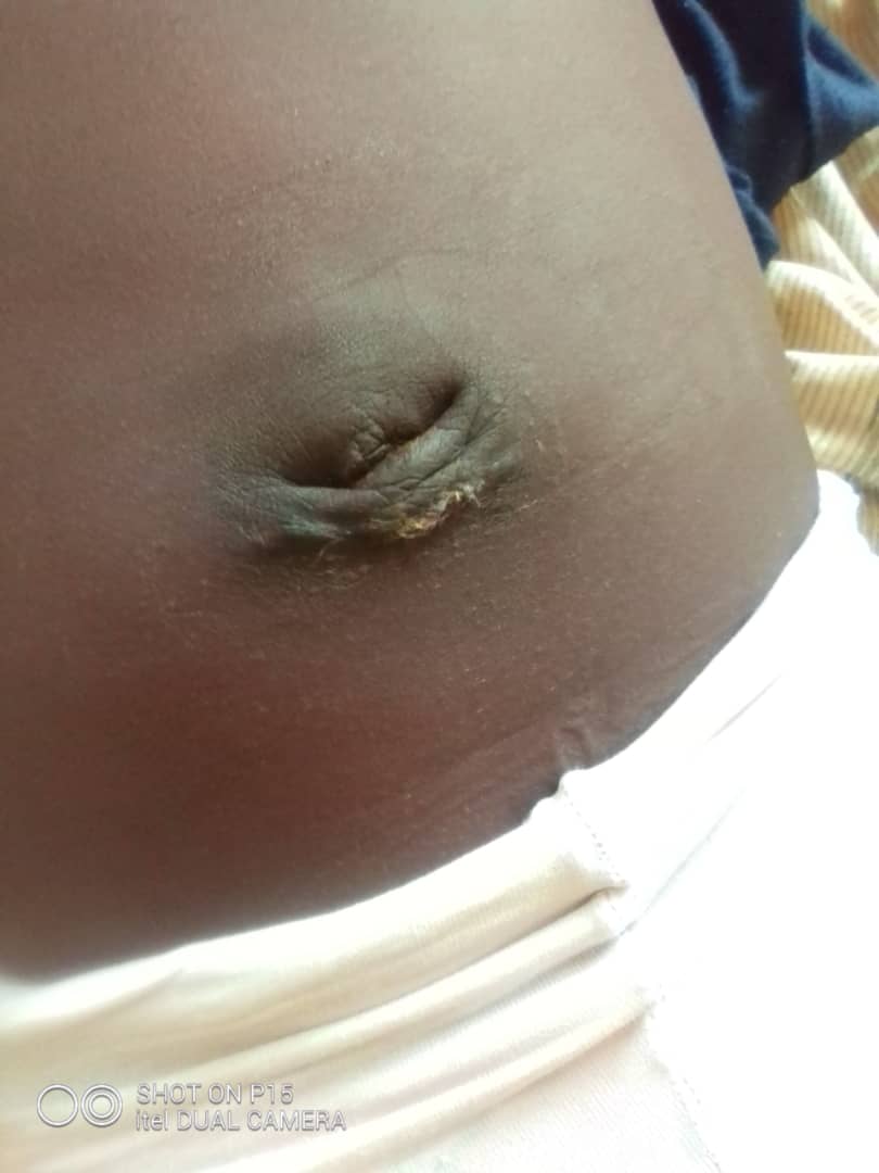 9 Year old hernia patient - 1 week after the operation